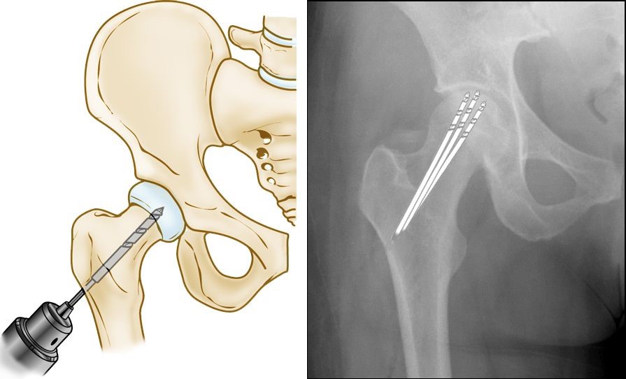 hip avascular necrosis image 4