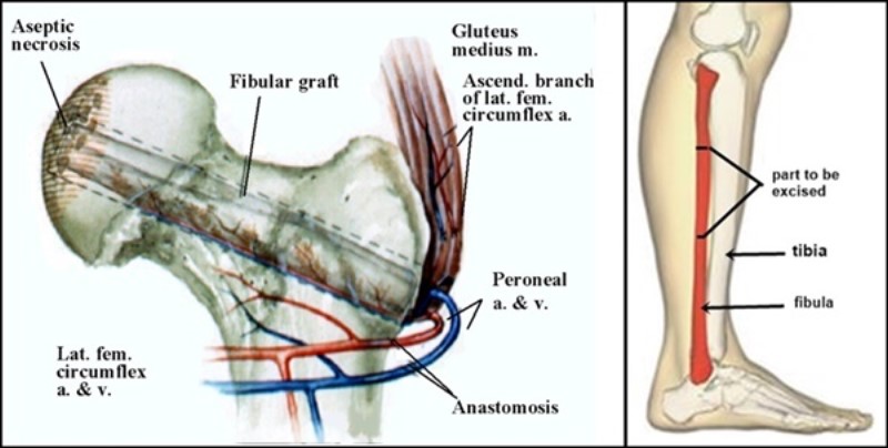 hip avascular necrosis image 5