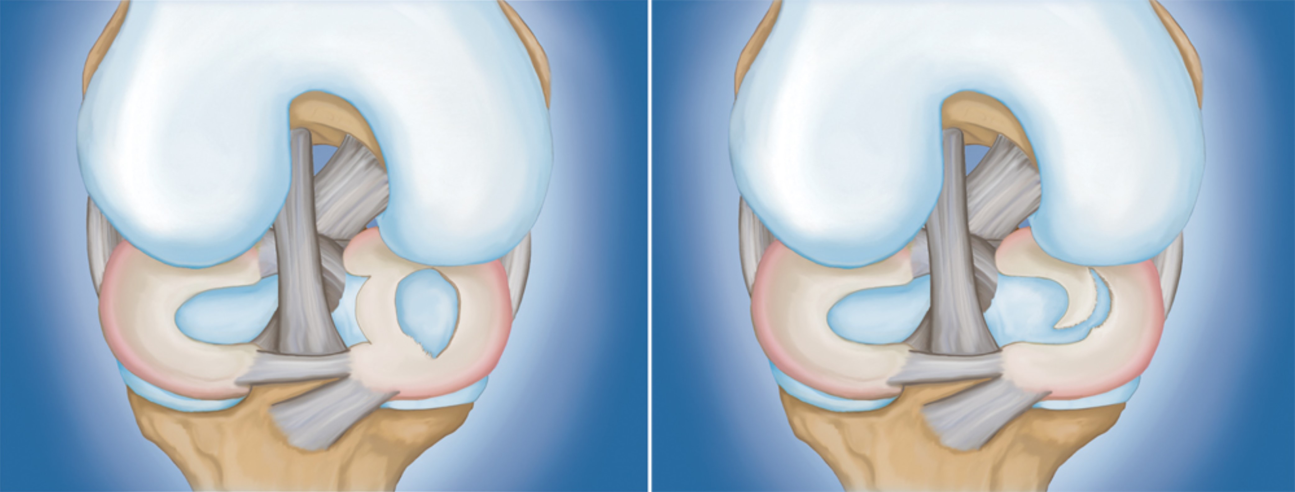 Meniscal tears 3