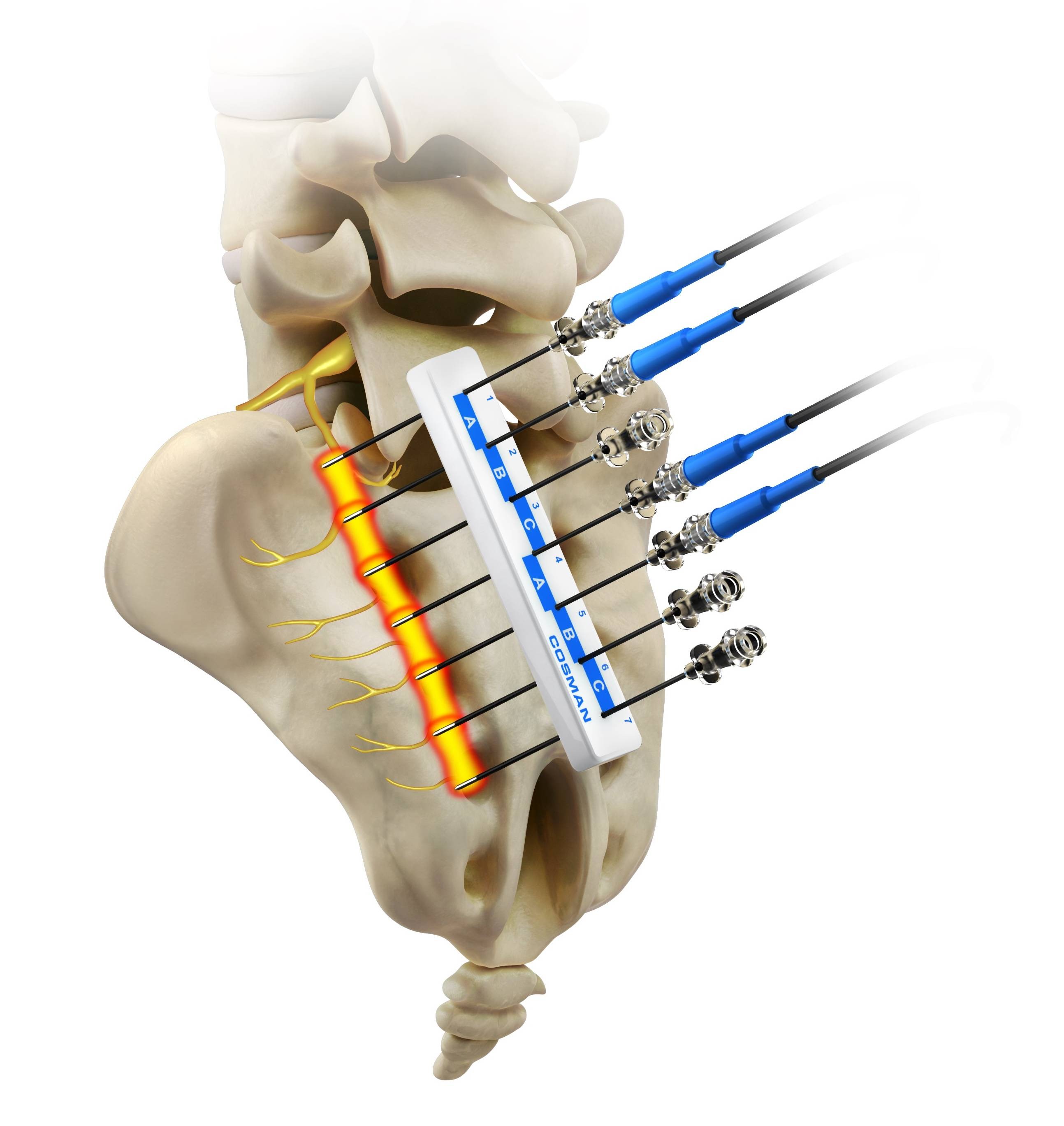 Sacroiliac Joint Dysfunction Treatment 2