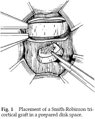 Cervical Radiculopathy 2