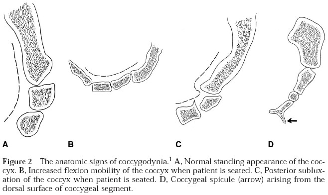 Coccygodynia 1