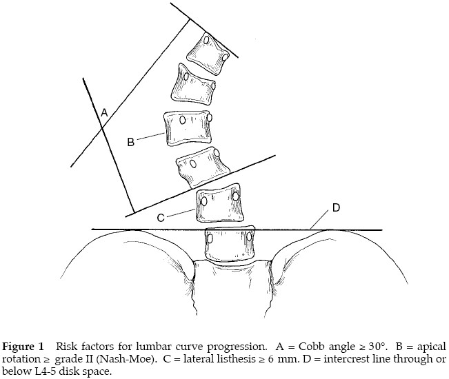 Degenerative Lumbar Scoliosis 1