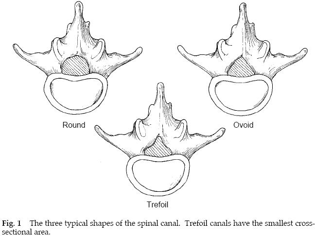 Lumbar Stenosis 1