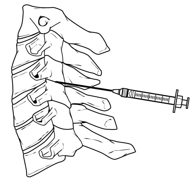 Facet joint injection in the cervical spine. 