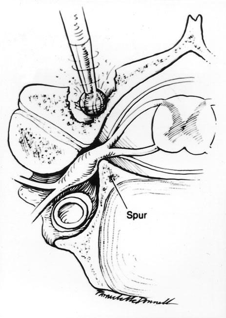 Illustration of a posterior cervical laminoforaminotomy